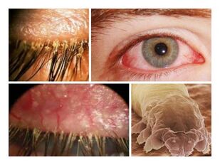 simptomi prisutnosti parazita ispod ljudske kože